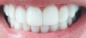 Odontologia Diseño de Sonrrisa en Resina