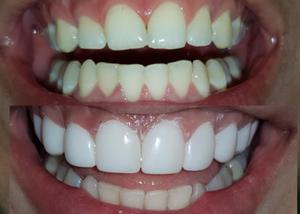 Odontologia Diseño de Sonrrisa en