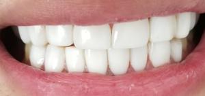 Odontología Diseño de Sonrrisa en Resina