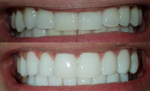 Odontologia Diseño Sonrrisa en Resina