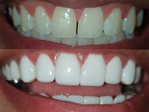 Odontología Diseño de Sonrisa en Resina