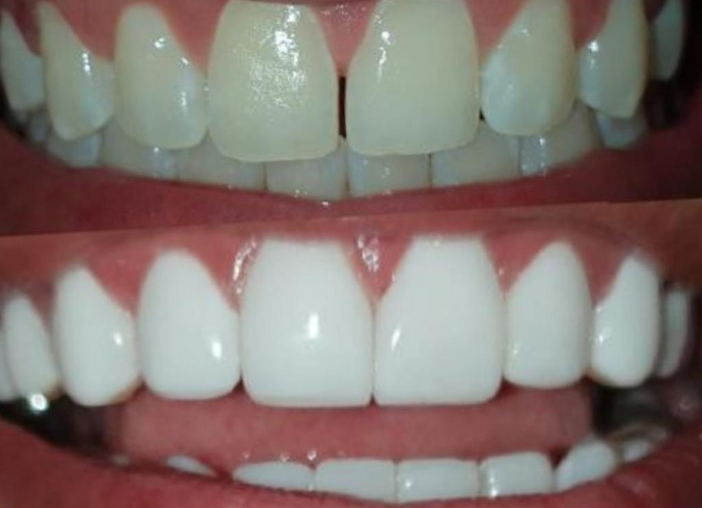 Odontología Estética Diseño de Sonrisa
