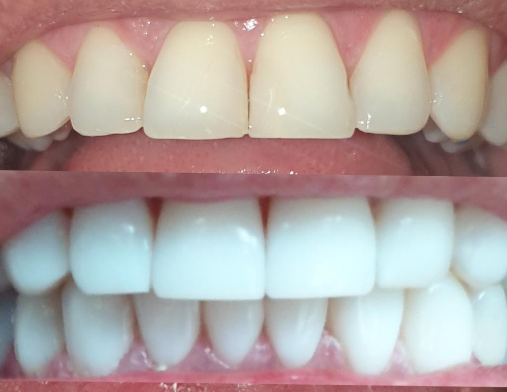 Odontología Estética Diseño de Sonrisa