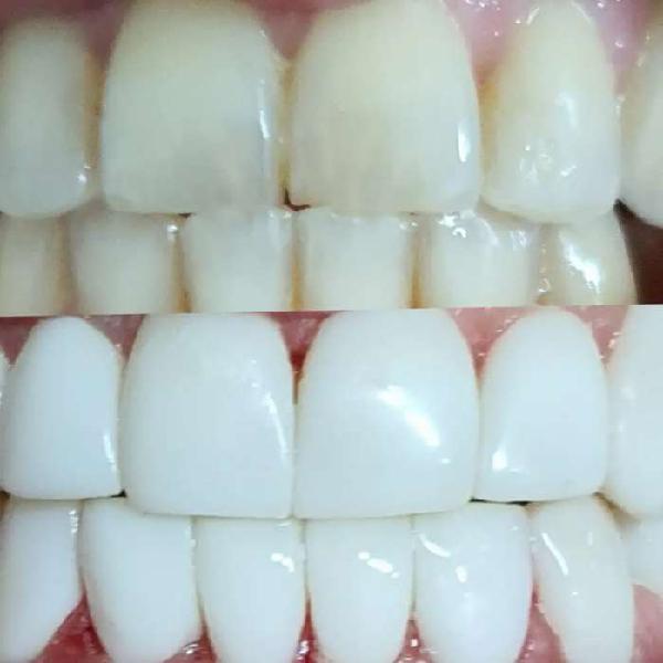 Odontología estética diseño de sonrisa en resina