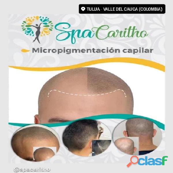 Calvicie Alopecia Tratamiento Con Micropigmentacion Capilar